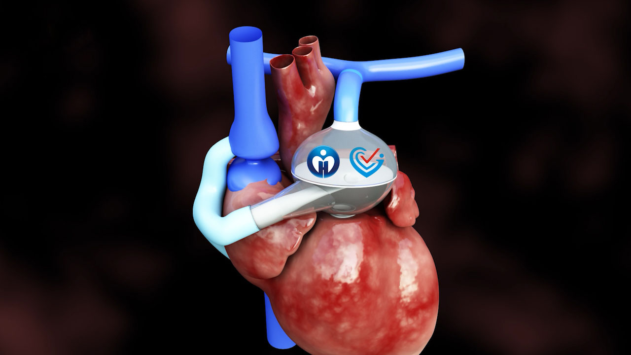 本款人工心脏是广东省人民医院为防治Fontan循环的心力衰竭而设计，是世界上唯一一款在结构上采用流入管穿过隔膜到达血室